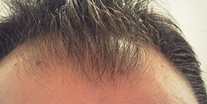 前頭部ヘアーリスペクトX3日目
